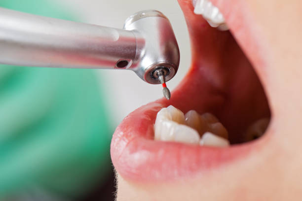 Best Broken or Cracked Tooth Emergency Dentist in Bryn Mawr, PA